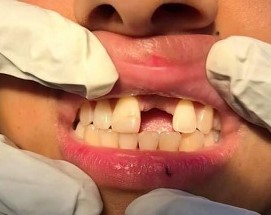 عملية جديدة لزراعة الاسنان